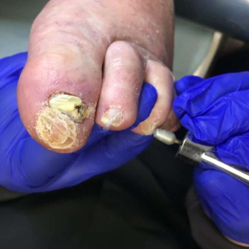 Trusted Foot Care Nurse in London, Ontario