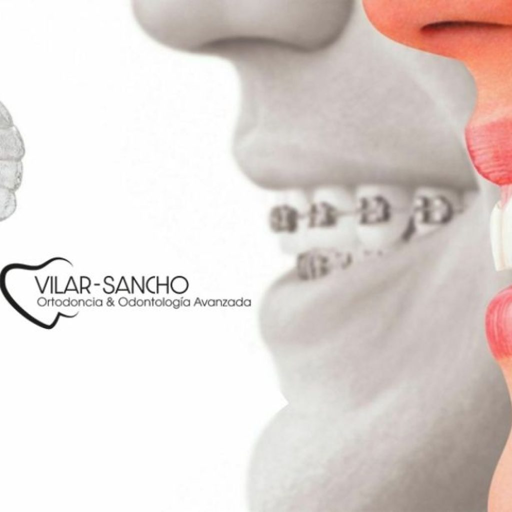 Sonrisa perfecta sin brackets en Pozuelo: ortodoncia discreta