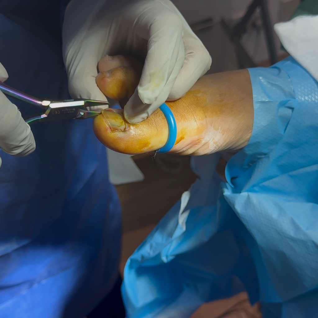 Relieve toenail pain with expert nail clinics in Birmingham Relieve toenail pain with expert nail clinics in Birmingham
