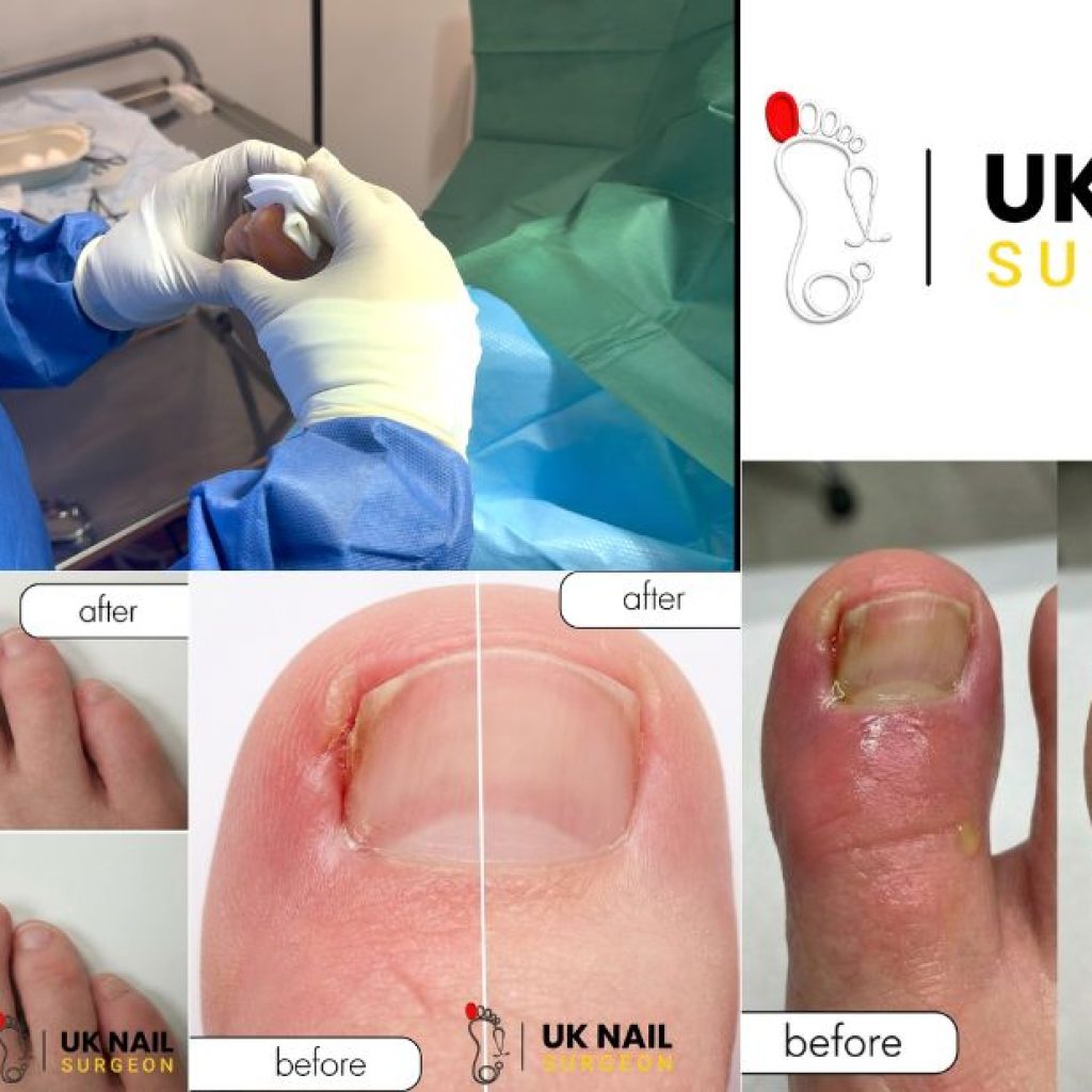 Effective treatment for troublesome fungal nails Effective treatment for troublesome fungal nails