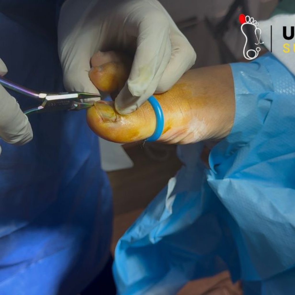 Foot Pain Relief: Expert Toenail Care in Birmingham